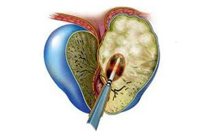 Проявление острого простатита
